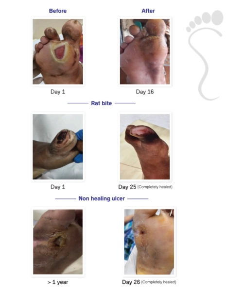 Before and After Diabetic Foot Ulcer Treatment